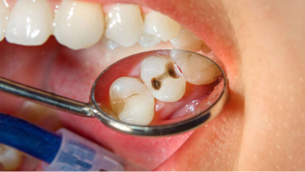 أسباب خسارة الأاسنان